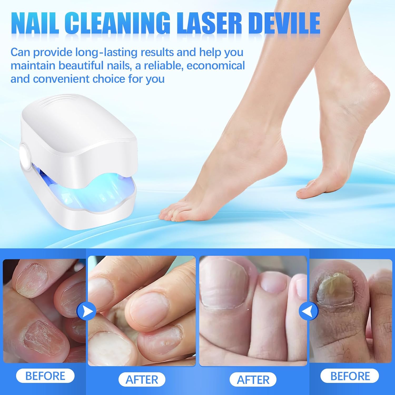 Rechargeable Nail Fungus Treatment for Toenail, Toe Nail Fungal Treatment Nail Fungus Laser Device, Anti-Fungal Nail Treatment for Hand & Feet Infections Remover for Home Use - Bhavnagar Deodap