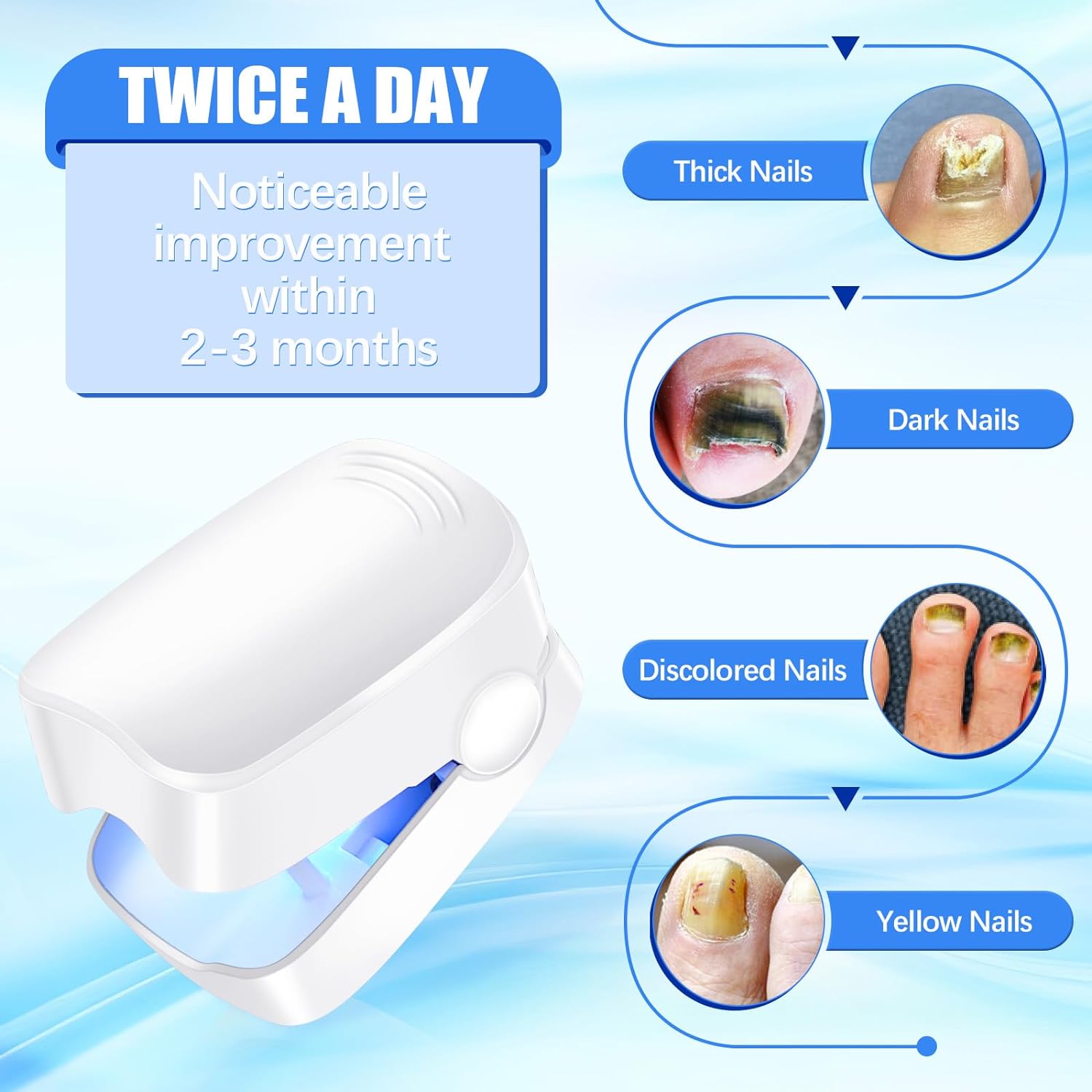 Rechargeable Nail Fungus Treatment for Toenail, Toe Nail Fungal Treatment Nail Fungus Laser Device, Anti-Fungal Nail Treatment for Hand & Feet Infections Remover for Home Use - Bhavnagar Deodap