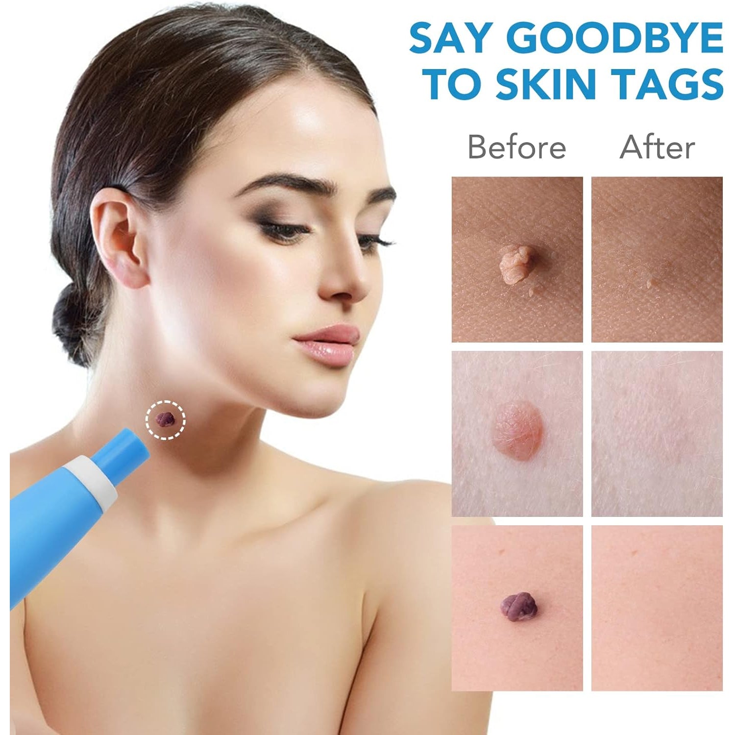 Skin Tag Remover Kit 2 in 1 for Micro to Large (2 mm - 8 mm / 1 Set) - Bhavnagar Deodap